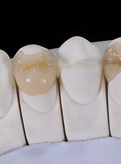 Model of tooth-colored fillings in Topeka & Silver Lake