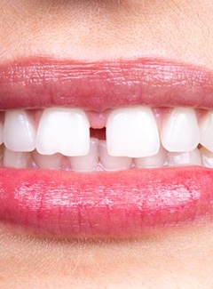 Person’s smile with gap between the front teeth