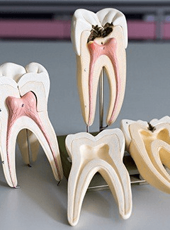 Model of tooth with root canal and healthy tooth