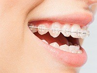 smile with clear braces