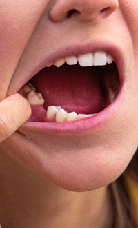Closeup of a missing tooth