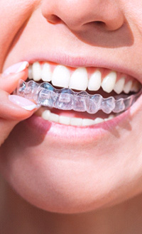 Woman putting in Invisalign aligners