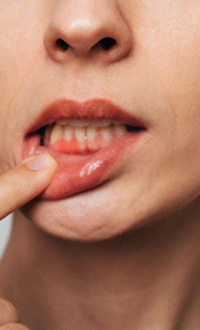 Woman with gum irritation