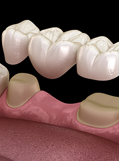 Illustration of bridge about to be placed on abutment teeth