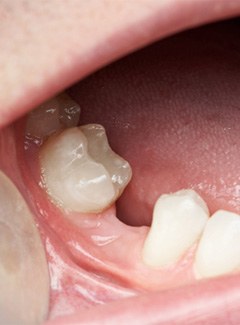 A close-up of a mouth with a missing tooth