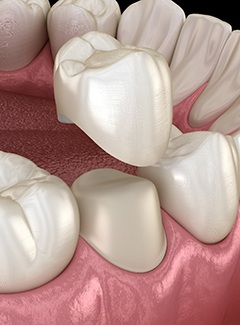 3D illustration of a dental crown capping a tooth
