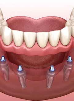 Implant dentures in Topeka & Silver Lake, KS being placed