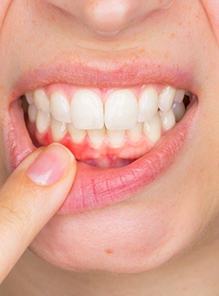 Woman pointing to abscessed tooth