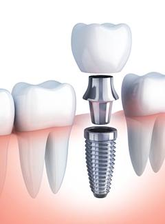 Diagram of a dental implant in Topeka and Silver Lake.