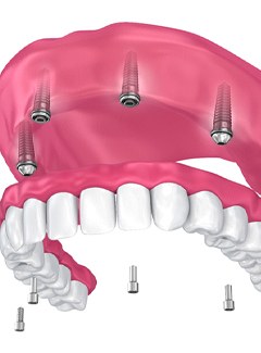 model of how implant dentures in Topeka & Silver Lake work