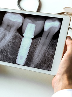 X-ray image after bone grafting in Silver Lake Topeka 
