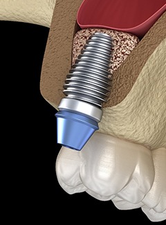 Diagram of sinus lift in Topeka Silver lake