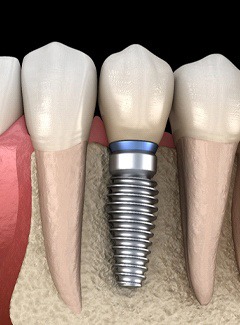 Diagram of dental implants in Silver Lake