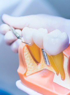Model of dental implants in Topeka 