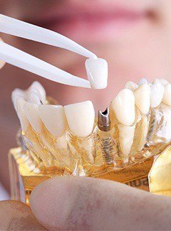 Model of dental implants in Silver Lake and Topeka 