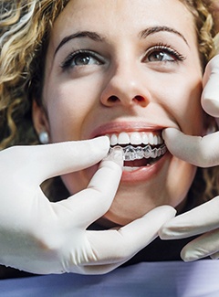 A dentist fitting a female patient with her first set of Invisalign aligners