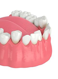 Illustration of crowded teeth in lower dental arch