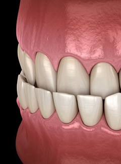 Illustration of underbite against dark background