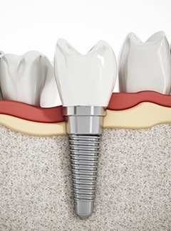 illustration of dental implant