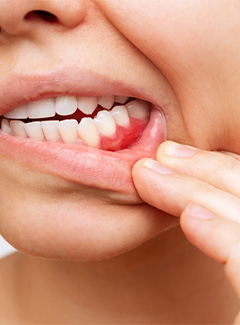 woman pulling lip down showing gum disease