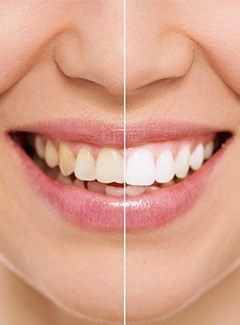 before and after whitening