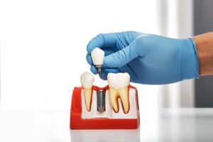 Gloved hand holding dental implant.
